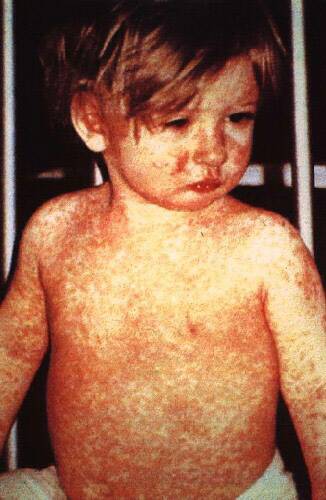 A child with measles.